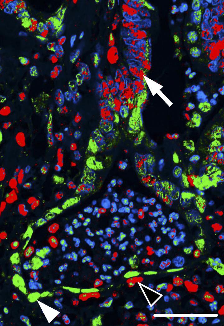 Human Colon Cancers Contain Two Populations of Cancer Cells