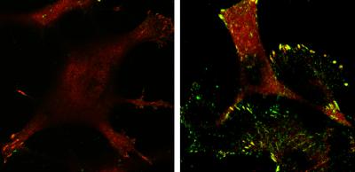 Invasive Tumor Cells (1 of 2)