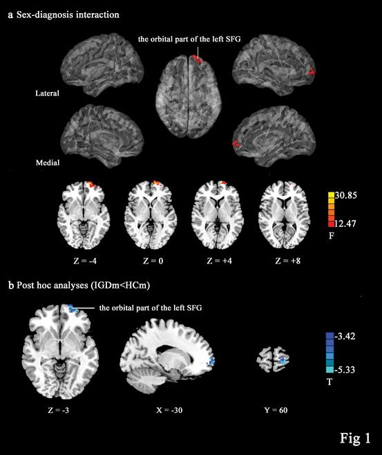 Images Show Brain Regions with Sex (Male, Female) and Diagnosis