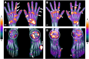 18F-FDG uptake in the hands and feet of participants with AIA