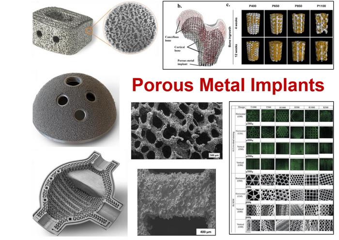 Porous metal implants can improve early-stage bone-bonding ability and help patients heal faster