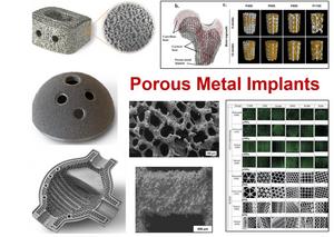 Porous metal implants can improve early-stage bone-bonding ability and help patients heal faster