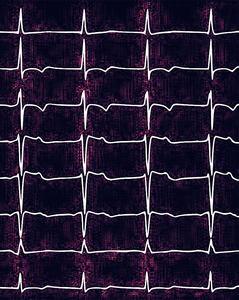 EKGs, AI and Pulmonary Embolism Screening