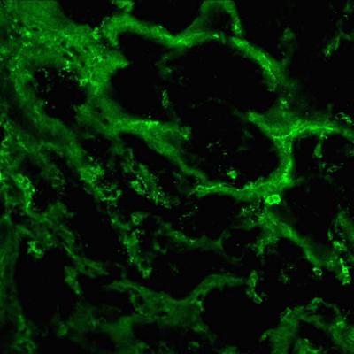 Factors Increase Blood Supply to Breast Tumors