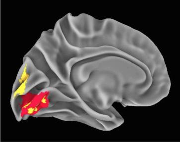 Visual Cortex Changes Related to Neanderthal Gene Variants