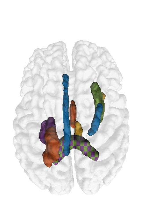 The top five white matter features (region pairs) in a single image.