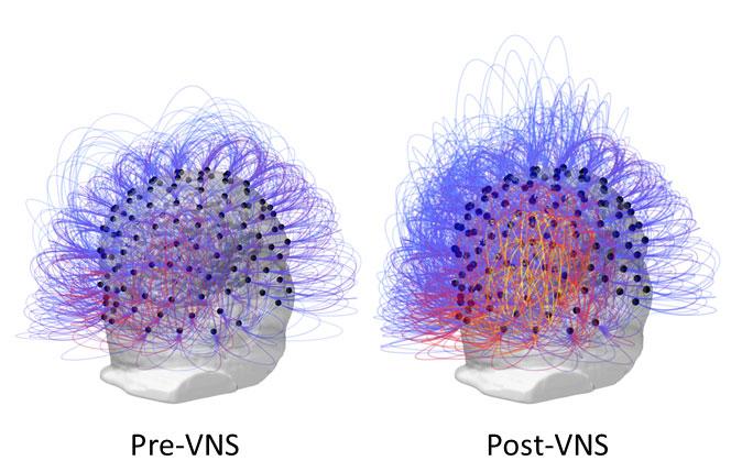 Before and After VNS
