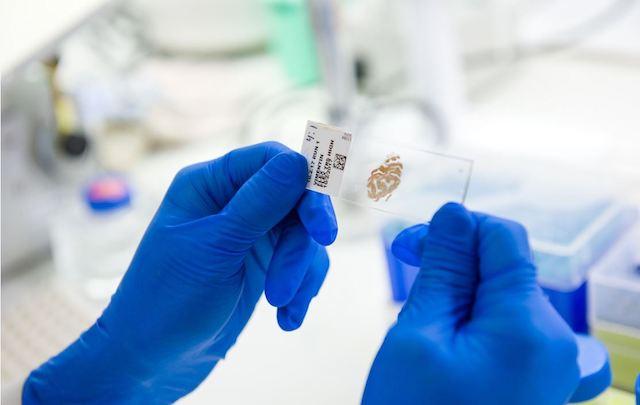 Section of a Renal Cell Carcinoma Tumor