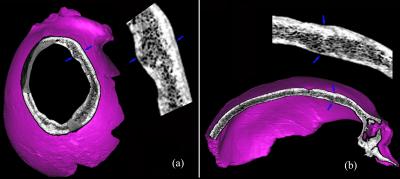 CT Reconstructions Depicting the Lesion on the Maba Cranium