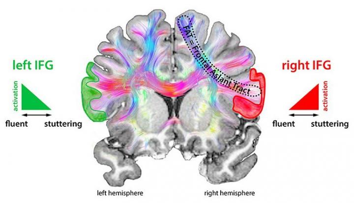 Structural Connectivity of Right Frontal Hyperactive Areas Scales with Stuttering Severity