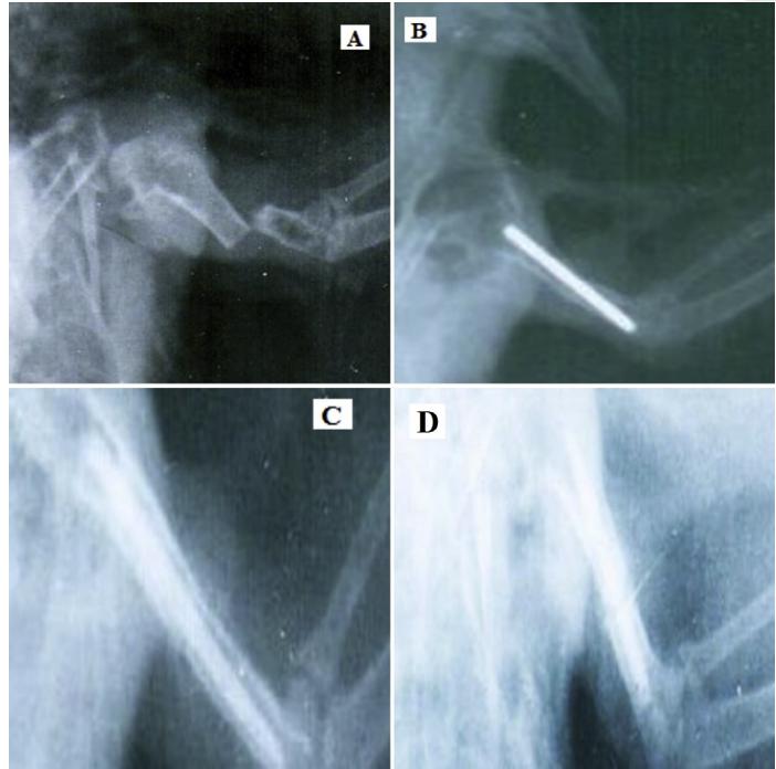 Bone Pin Treatment for Pigeon Wing Fracture