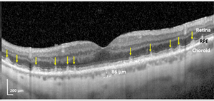 Damaged retina of study participant with a previous heart attack