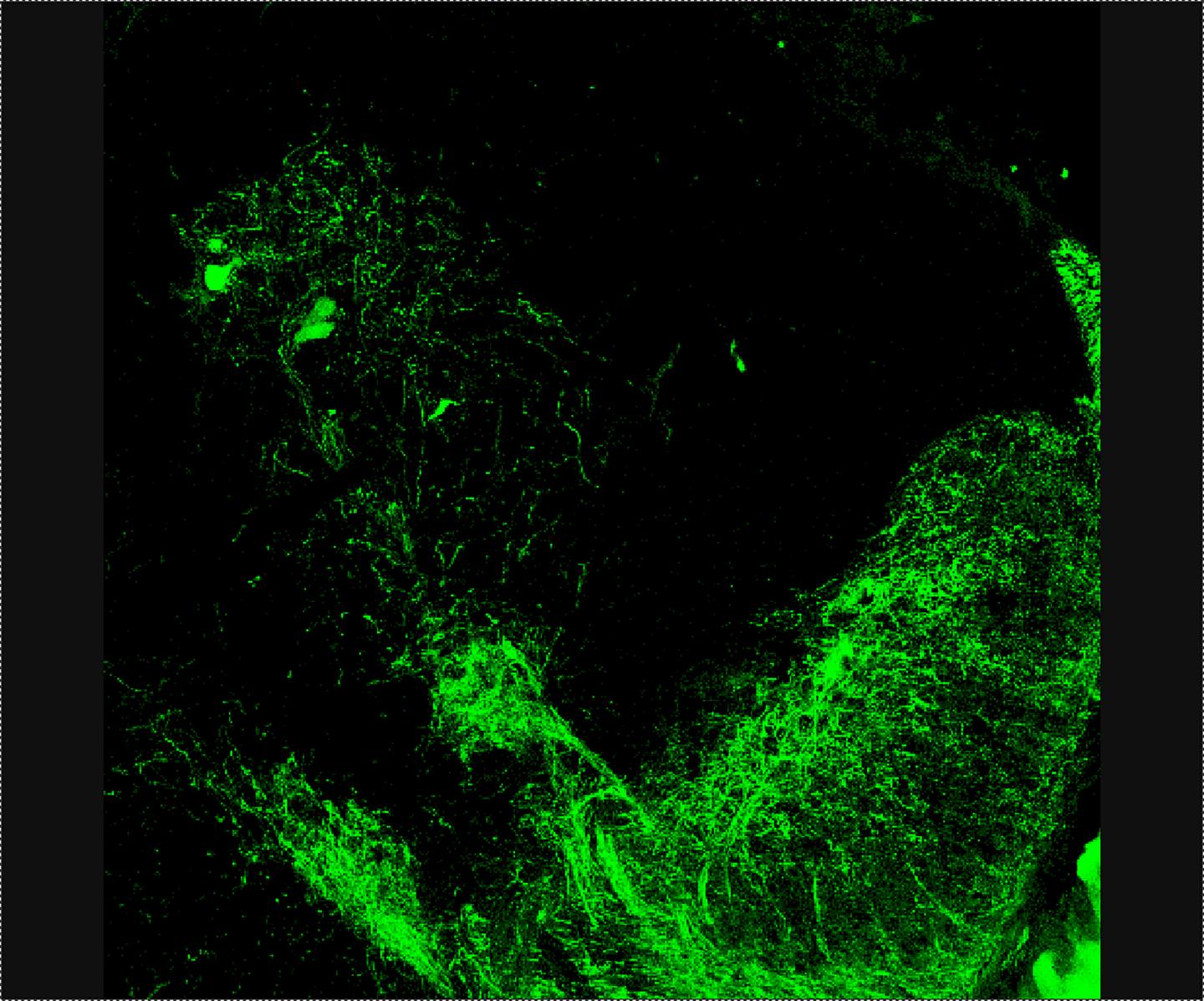 Gene Therapy for Spinal Muscular Atrophy (1 of 1)