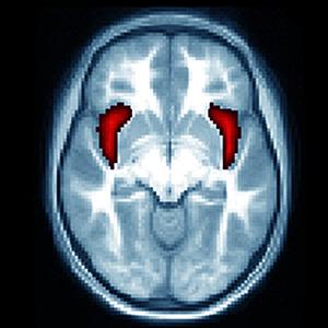 Brain Images from Children Who had Preschool Depression