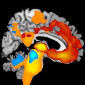 Brain MRI Showing Disease Progression over Time