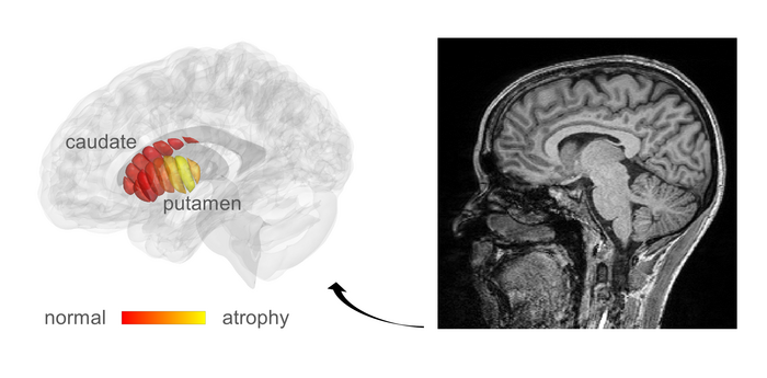 Description: MRI images used for automatic detection of microstructural changes in early-stage Parkinsons Disease (PD) patients.  Marked in yellow are areas in the putamen where PD patients show tissue damage, compared to healthy controls.