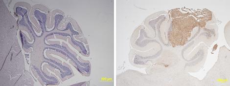 Coupe de cervelet normal (à gauche) et envahi par un médulloblastome (à droite). 