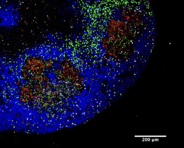 Why Your Kid's Strep Throat Keeps Coming Back