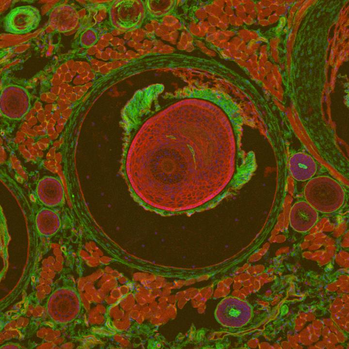 Important Insight into a Calcium-Accumulating, Rare Genetic Disorder (2 of 4)