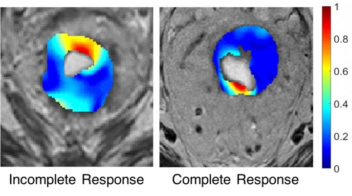 Rectal Cancer Images