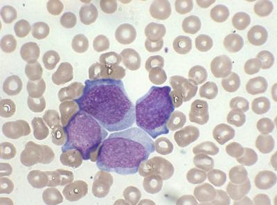 Genetic Link to Leukemias with an Unknown Origin