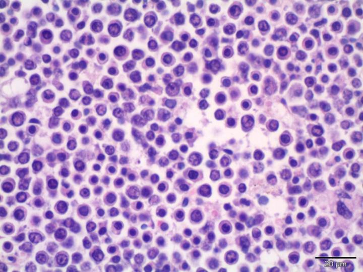 Multiple Myeloma