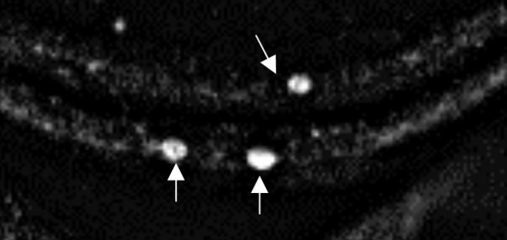 Alpha-Synuclein Aggregates