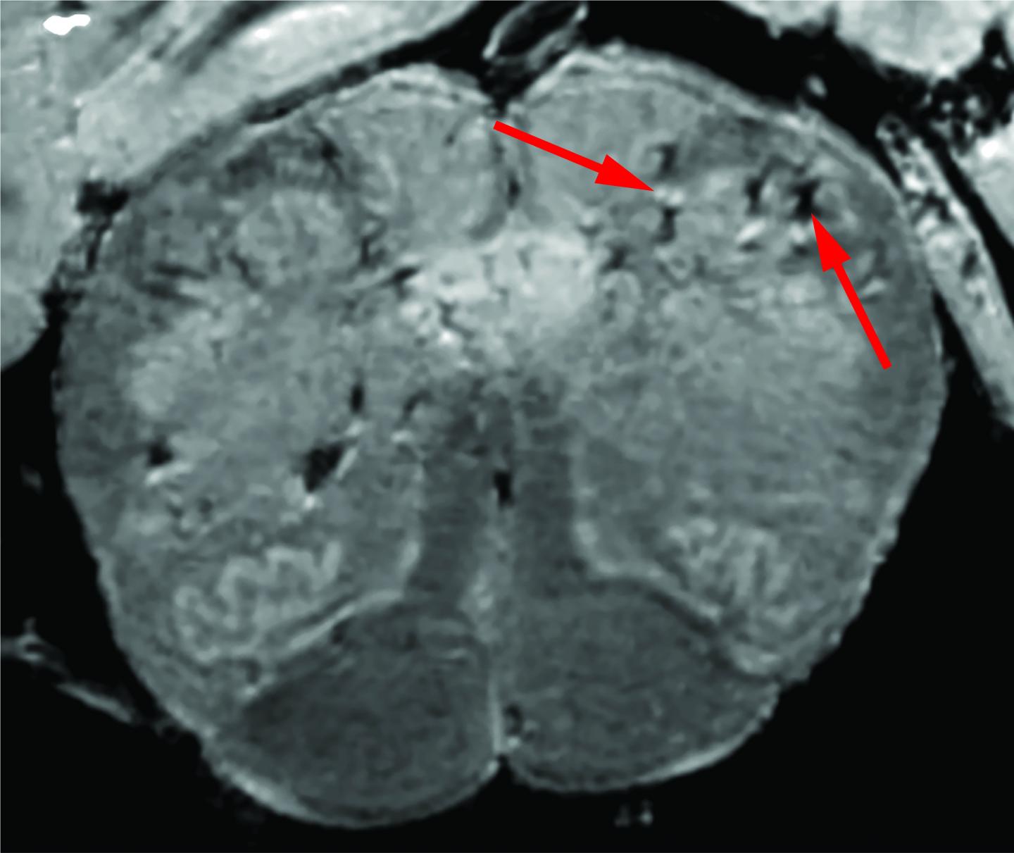 COVID-19 Brain Damage