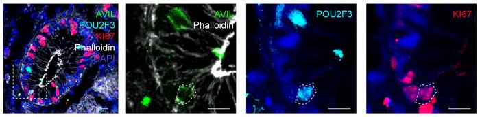 Co-staining of AVIL with KI67 and POU2F3 in human primary colon tissue