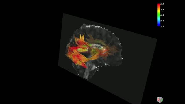 Structural Changes in Children's Brains as a Result of Traumatic Brain Injury