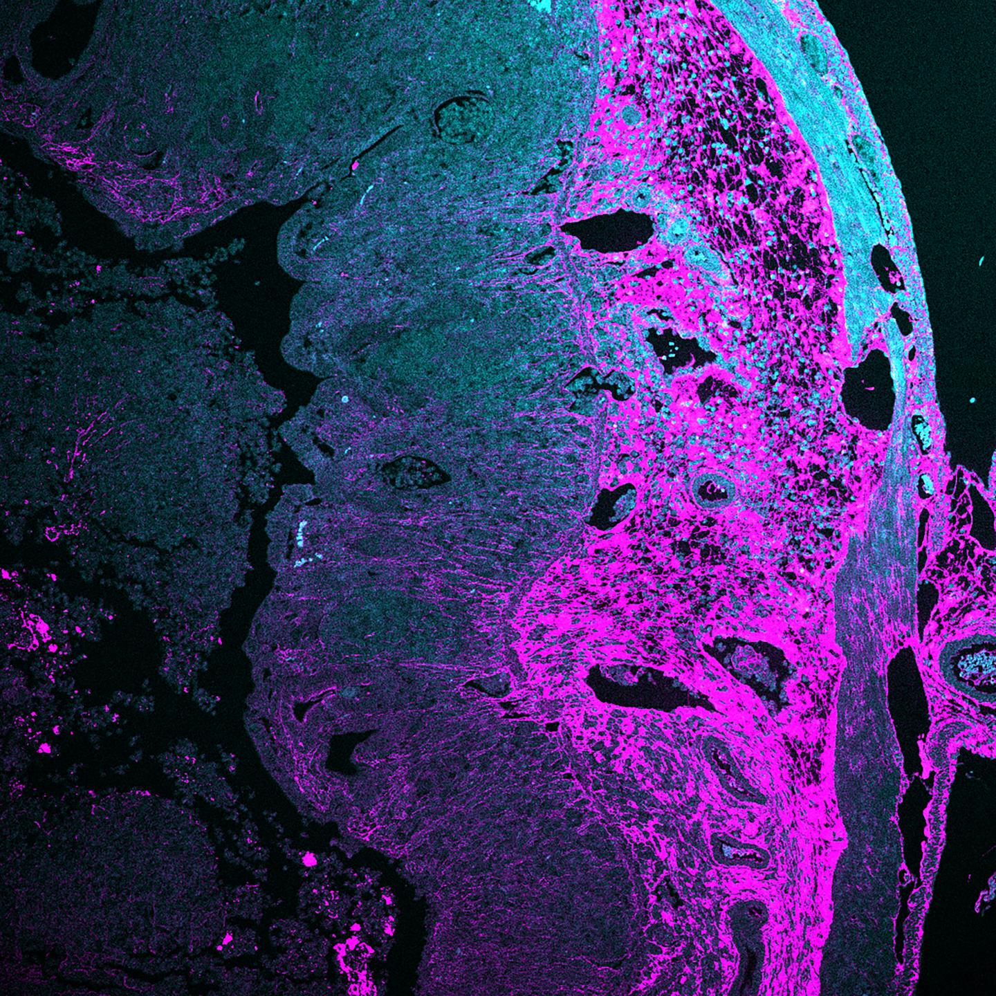 On the Road to Therapy for Crohn's-Related Fibrosis (3 of 9)