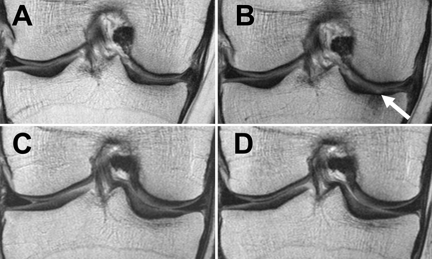 MRIs of the Right Knee