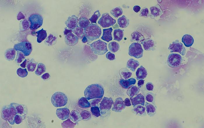 Leukaemia cells with the BIM variation under a microscope