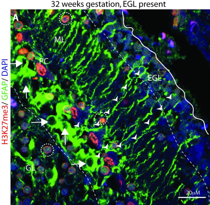Prognostic Marker for Childhood Brain Cancer EurekAlert!