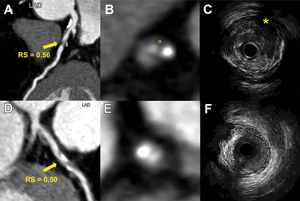 Researchers Use Radiomics to Predict Heart Attacks