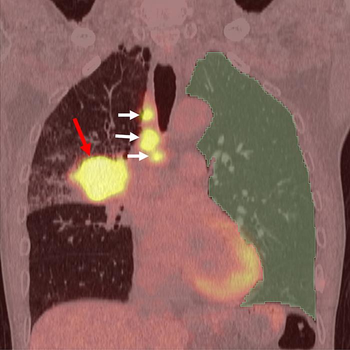 Example of AI analysis of PET/CT images