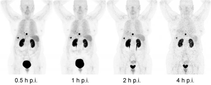 Biodistribution of 188 MBq 68Ga-OPS202 (15 &#956;g) at 0.5, 1, 2, and 4 h Post Injection in Patient 2