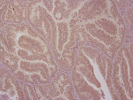 Endometrial Cancer Cells