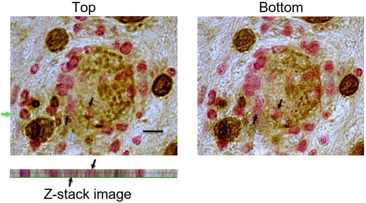 toxoplasmosis gondii cysts