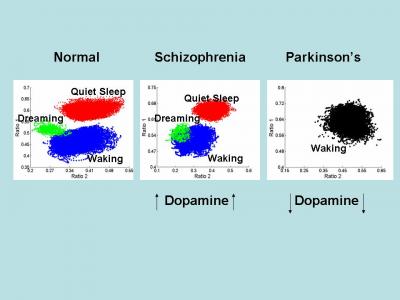 dopamine neurotransmitter schizophrenia