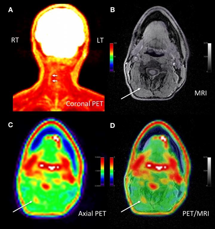 Adult male with decades of right neck pain, discomfort and tightening following birth injury.