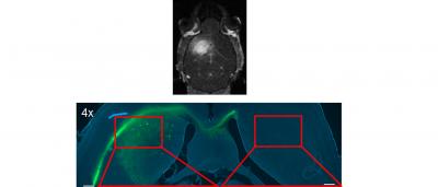 Microbubbles and Ultrasound open the Blood-brain Barrier to Administer Drugs II