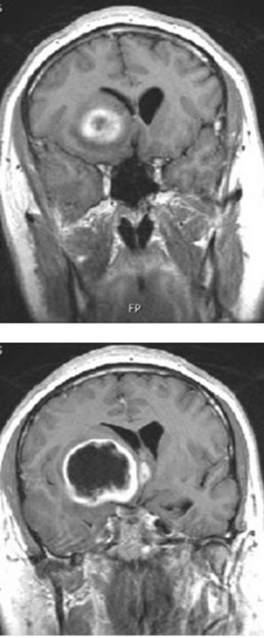 UTSW scientists identify pathway to curb spread of brain cancer