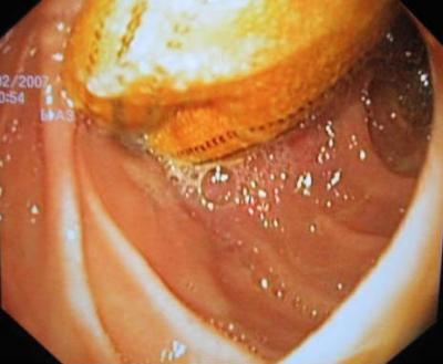 Esophago-gastro-duodenoscopy
