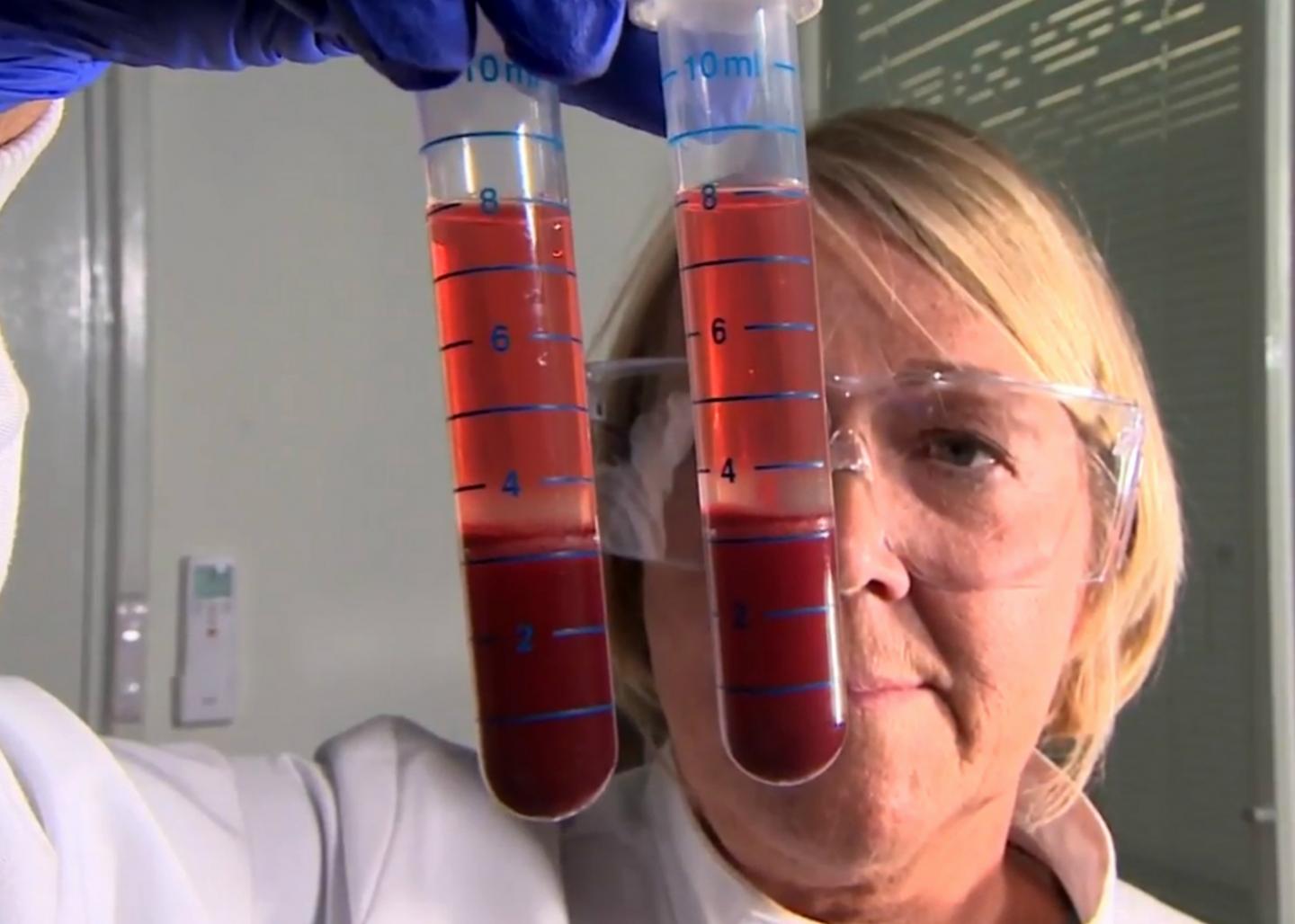 New Blood Test For Human TB May Also Identify People At Most Risk 