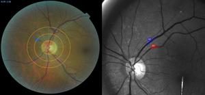 Blood vessels in the eye