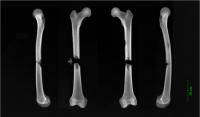 X-rays of femur fractures found on a friar