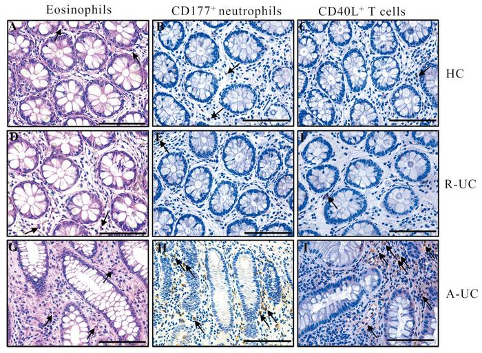 Novel inflammatory cell enumeration index (ICEI) can predict the risk of deterioration in patients with ulcerative colitis