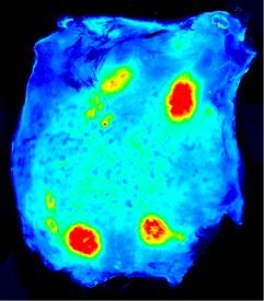 Scientists Unravel Likely Causes of Blood Vessel Leakage in Severe Dengue