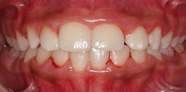 Periodontitis in Children